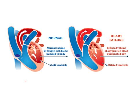 what is lvsd heart failure